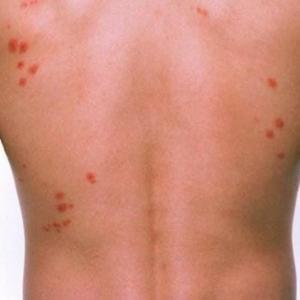 Cimici dei letti o bed bugs, come difendersi? Cimici dei letti o bed bugs, come difendersi?